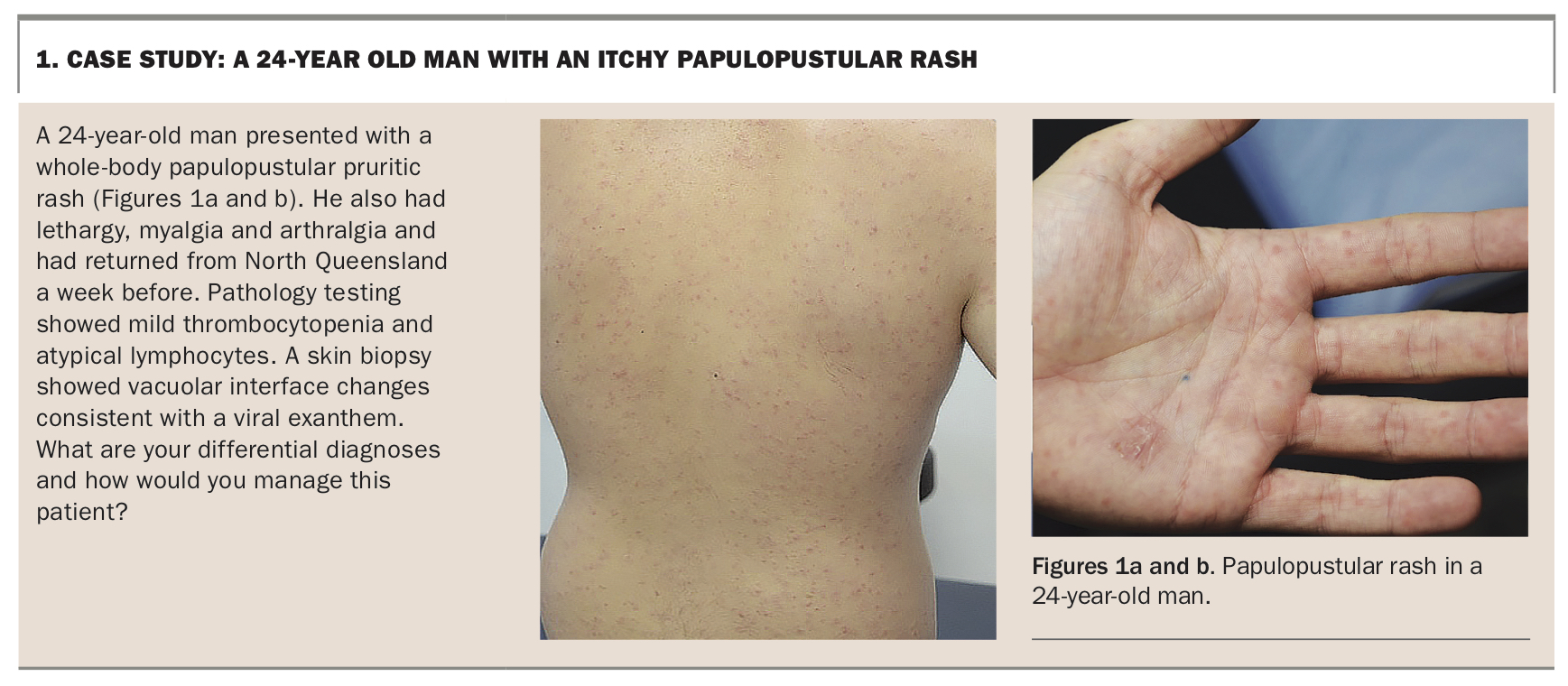 unilateral-laterothoracic-exanthem-treatment